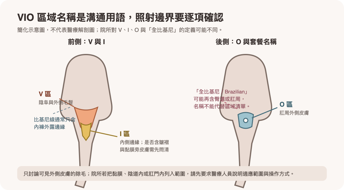 VIO私密處除毛常見區域示意:V區、I區、O區與比基尼線
