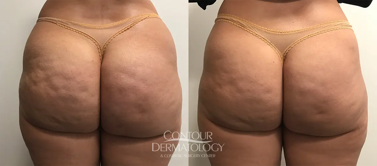 Contour Dermatology 公開的 VelaShape III 臀部橘皮五次療程前後照片，圖片已存於本地