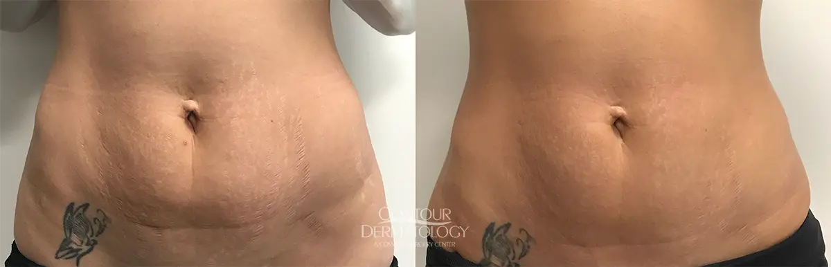 Contour Dermatology 圖庫標示 VelaShape 腹部六次療程的前後病例照