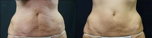 Diane Walder Dermatology 公開的腹部 VelaShape 三次療程前後照