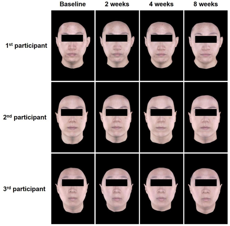 Volnewmer 單極射頻研究的三位參與者正面基線、2、4、8 週影像;原始論文 Figure 2,CC BY 4.0