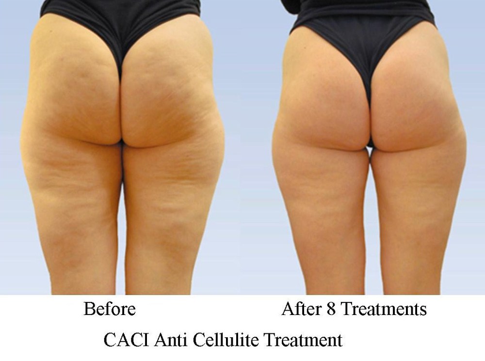 Images Hair & Beauty 公布的 CACI 抗橘皮臀腿療程前後照,標示完成 8 次療程,圖片已下載至專案本地