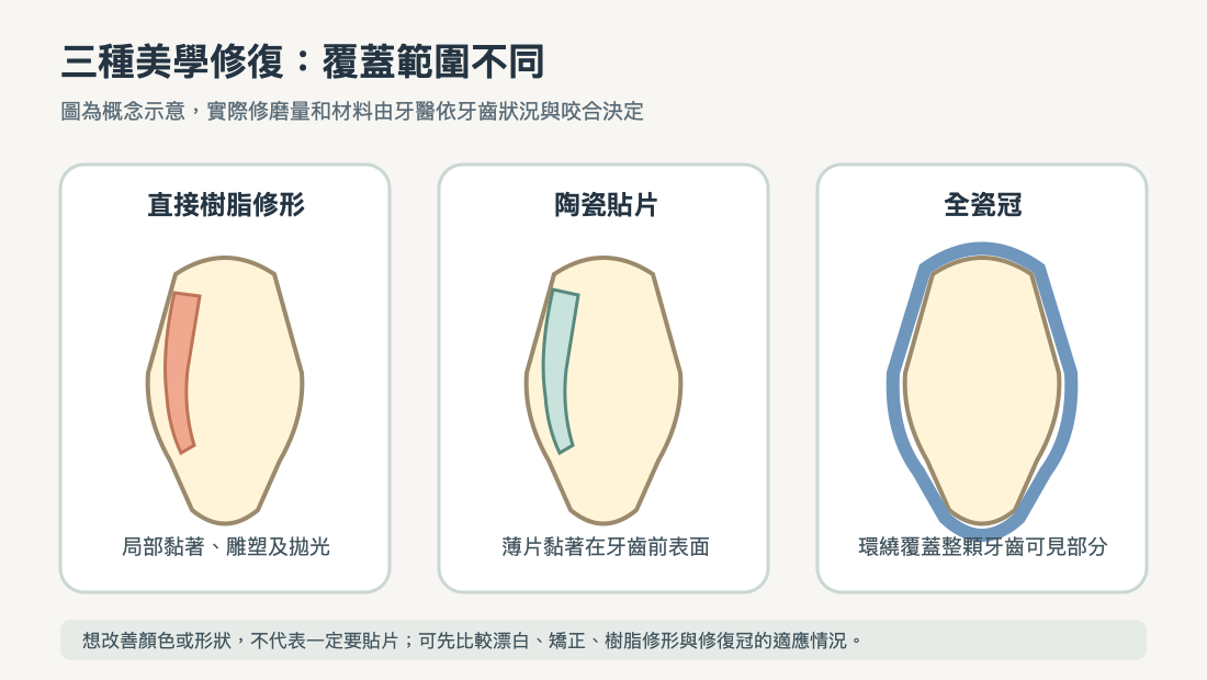 樹脂貼片、陶瓷貼片與全瓷冠覆蓋範圍比較