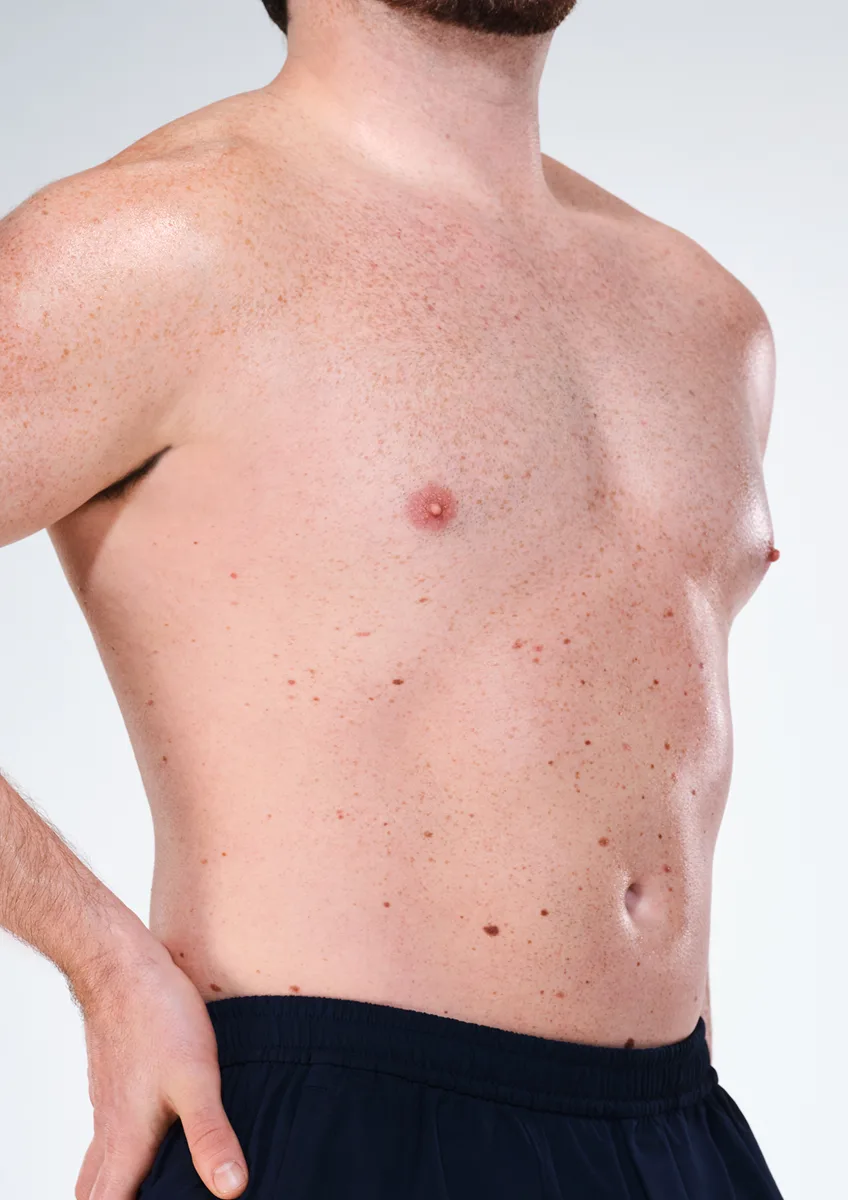 CoolSculpting Elite 官方公開真人案例,完成三次療程後 14 週腹部照片