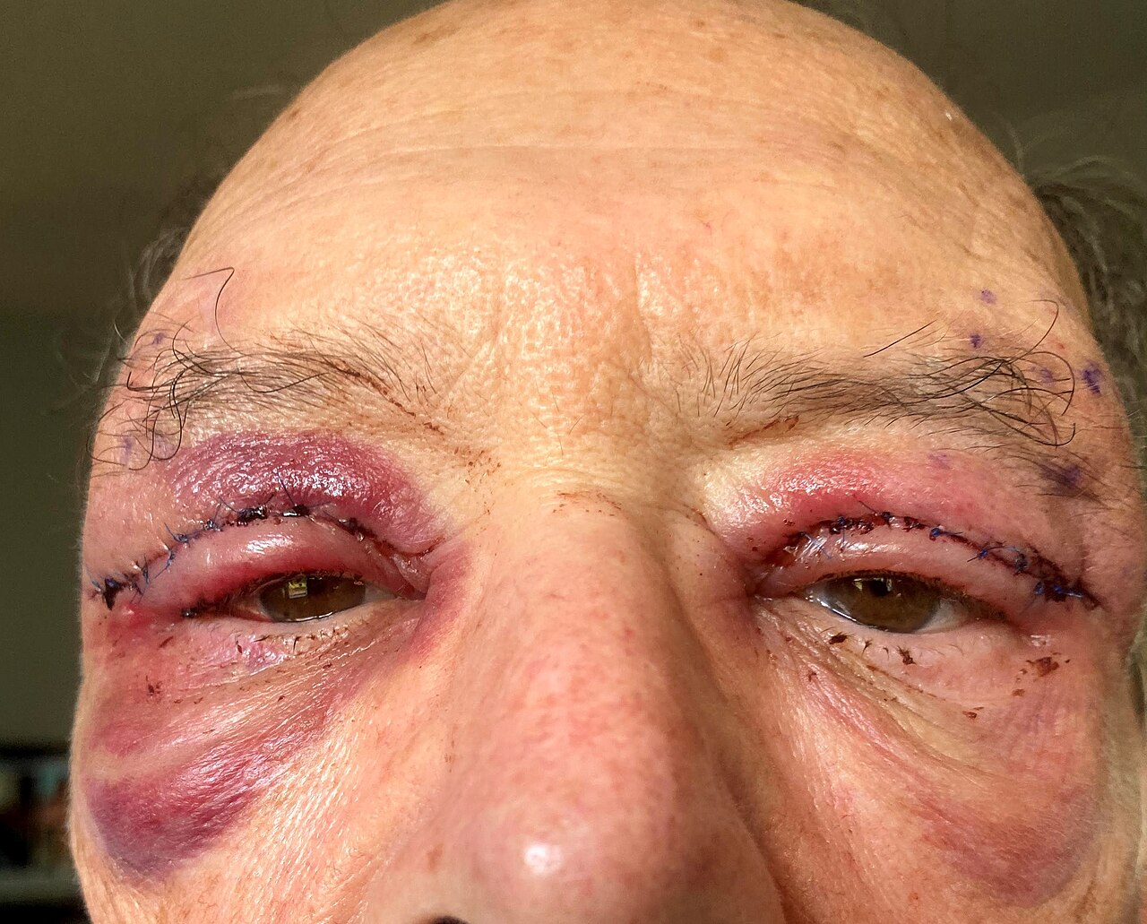 上眼瞼手術後一天的腫脹與瘀青個案照片