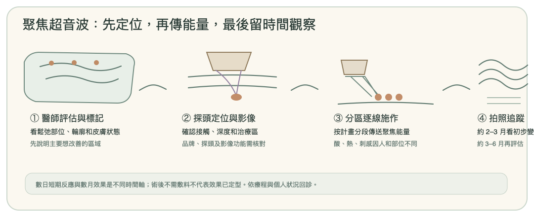聚焦超音波從醫師分區、影像定位、分段傳能到數月後評估的手繪流程