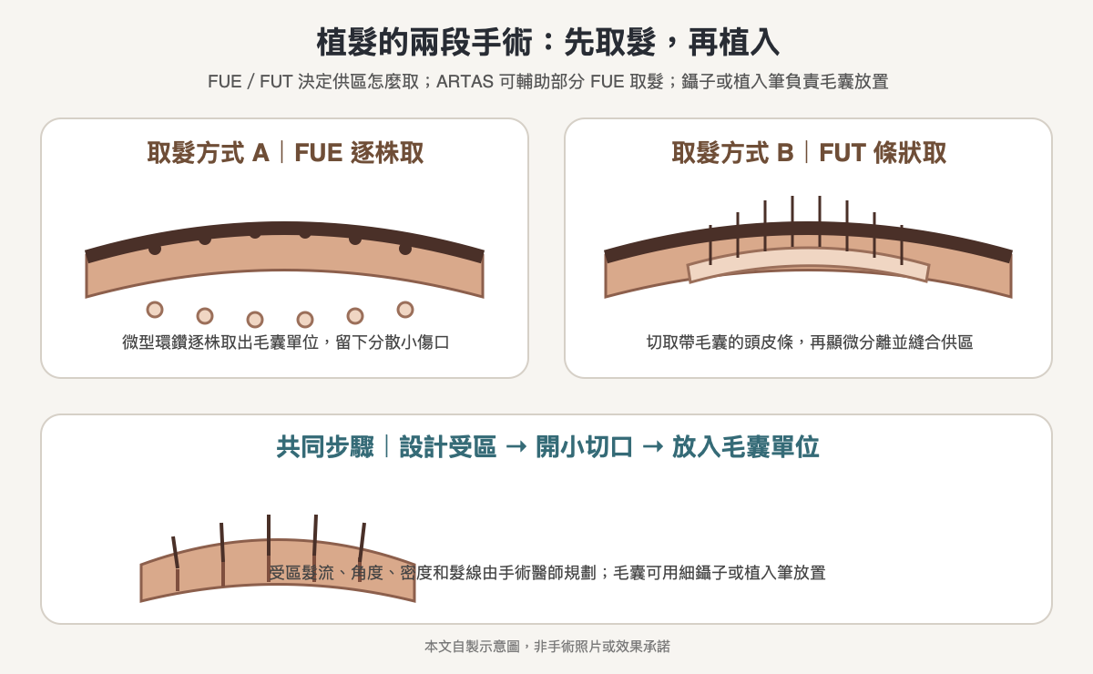 FUE與FUT取髮、ARTAS輔助取髮及受區植入方式比較示意