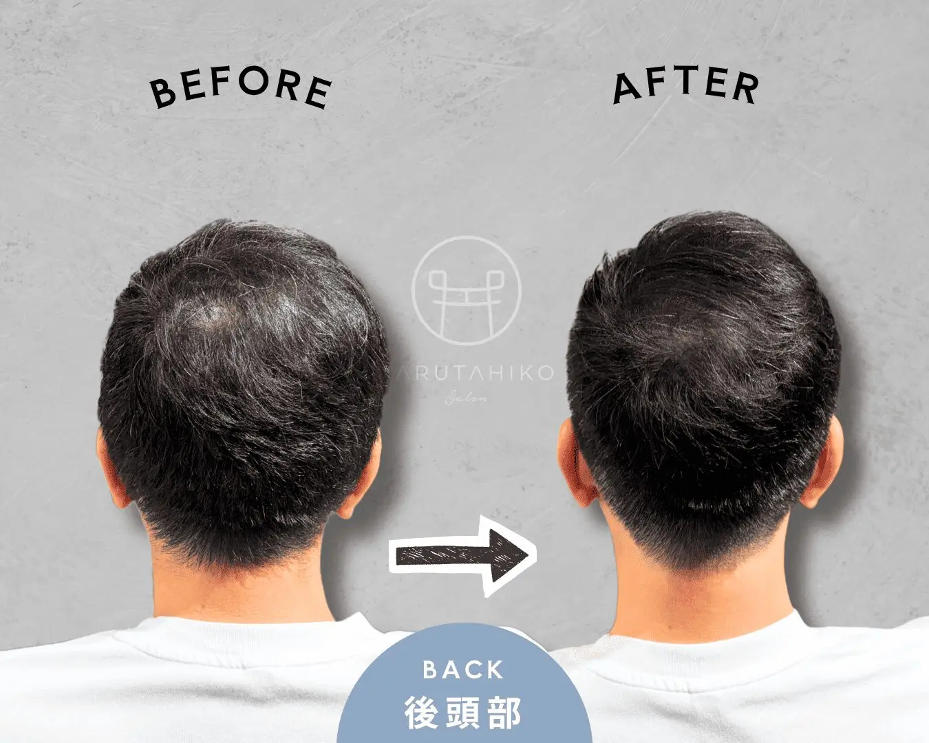 日本剪裁案例的後腦 BEFORE/AFTER 原圖,可直接比較髮旋周圍與後腦輪廓