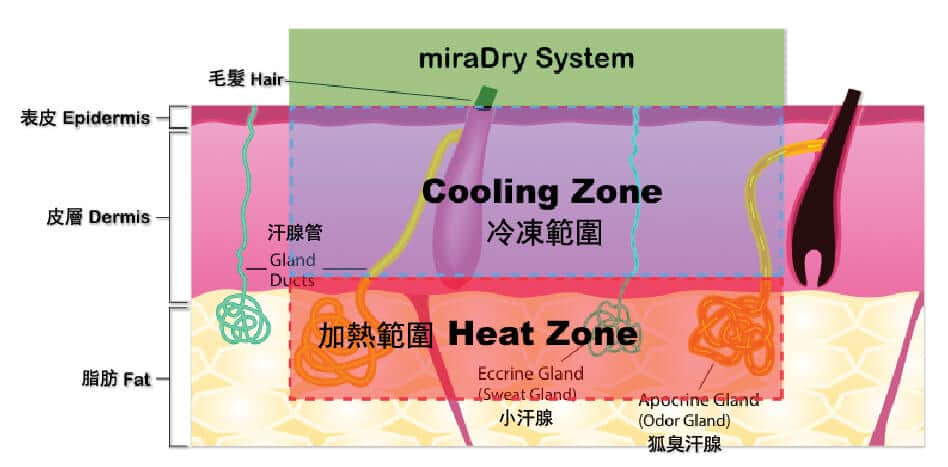 miraDry 微波加熱區與表面冷卻區的診所示意圖,非真人治療照片