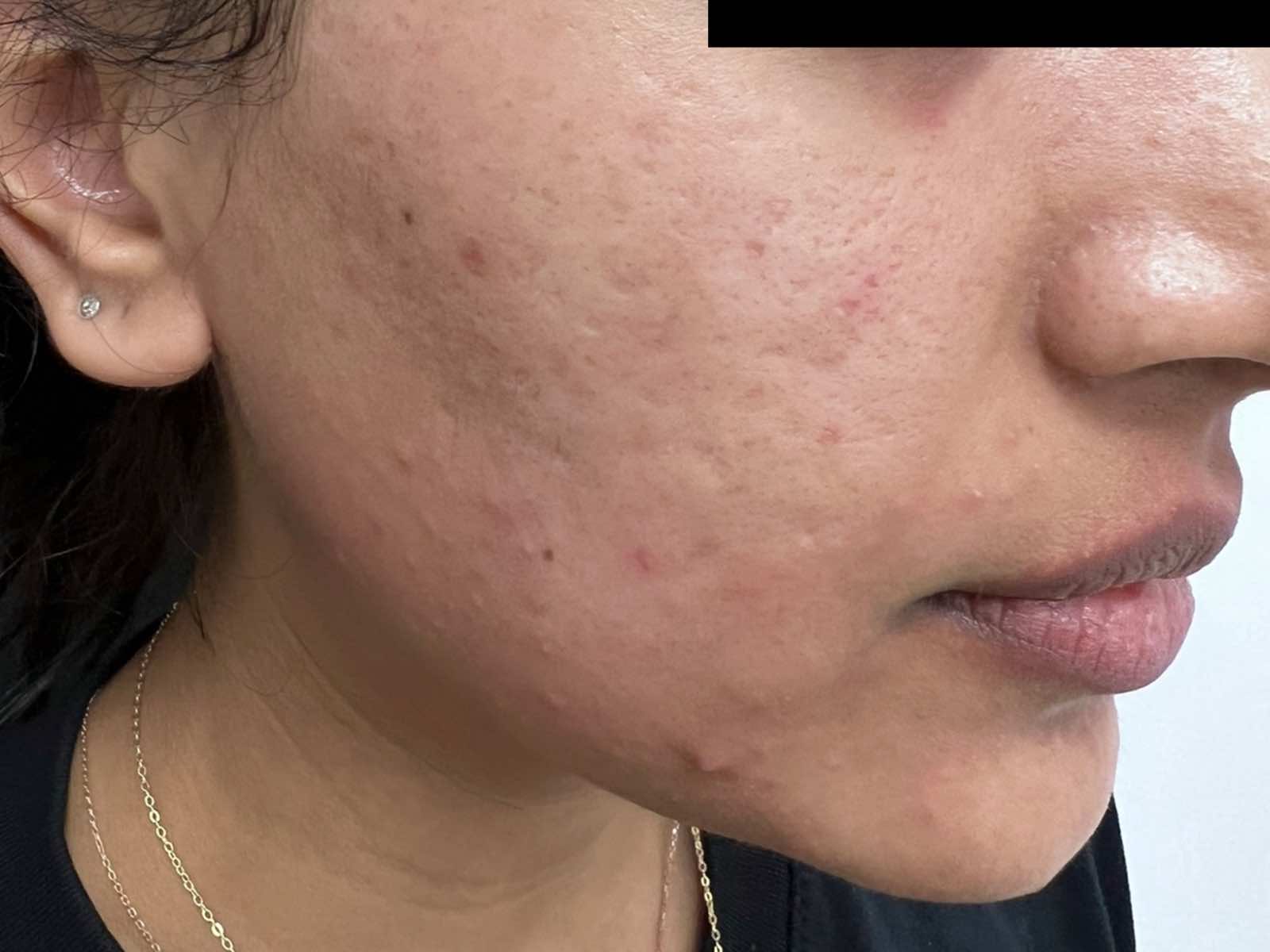 Cutera Secret RF 單一病例治療前的臉頰痘疤與膚質,原廠公開照片;Tatiana Lapa 醫師提供