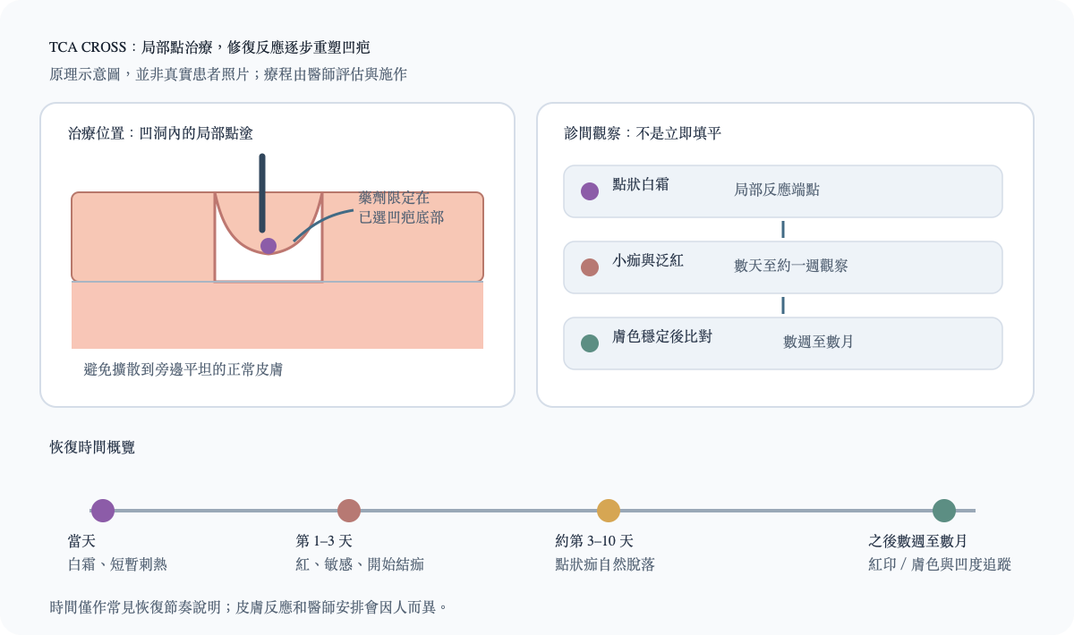 TCA CROSS 凹疤點狀治療示意圖:選定凹洞、局部重建、點狀結痂與後續比較