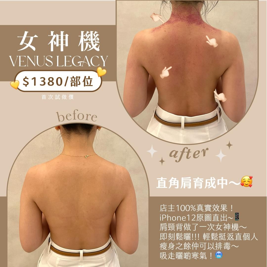 香港 Refinery Beauty 公開的肩頸背單次療程前後展示圖；圖片同時標示首試價 HK,380／部位，已下載到本文本地 assets
