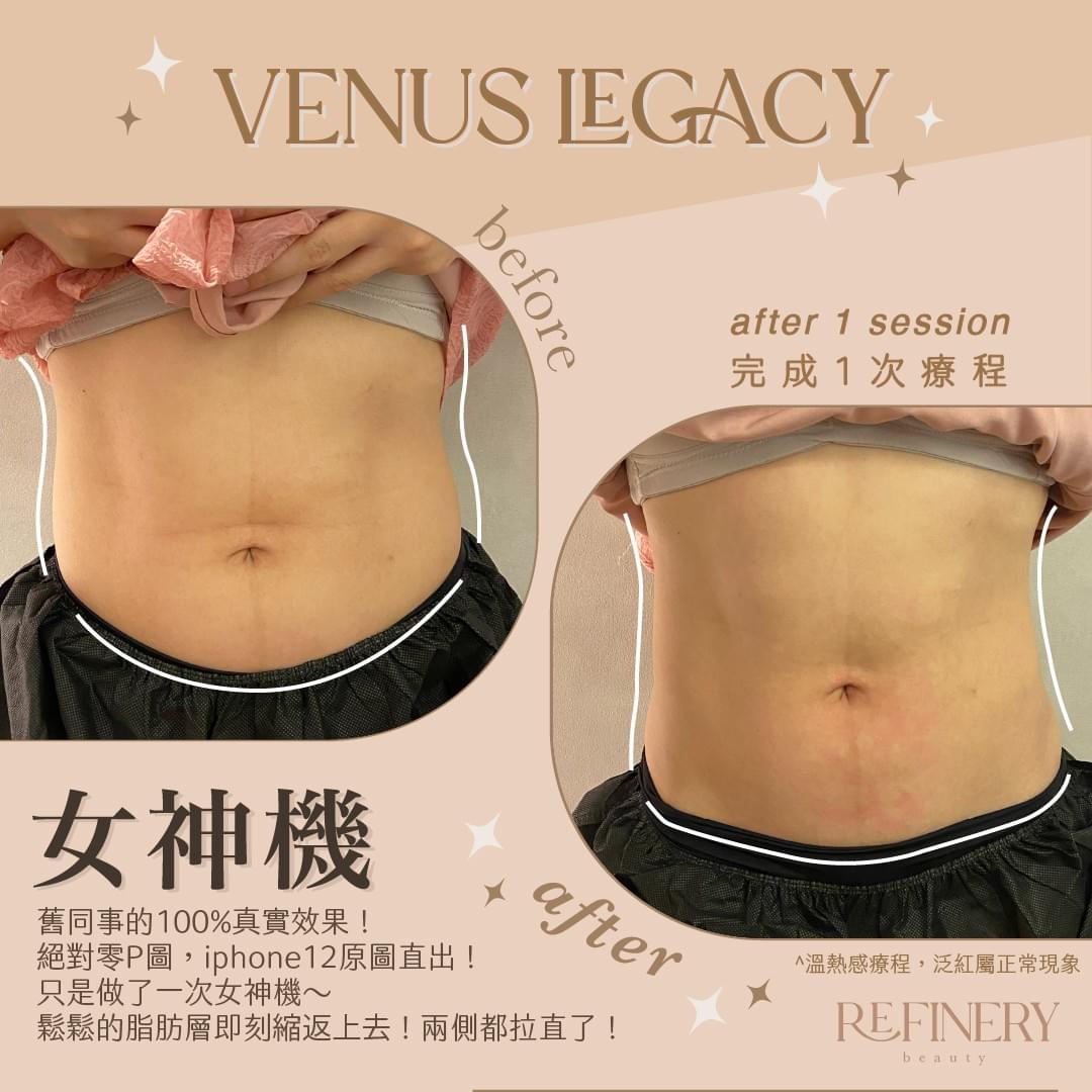 香港 Refinery Beauty 公開的 Venus Legacy 腹部一次療程前後展示照，原圖含 Before／After 標示；已存於本地 assets