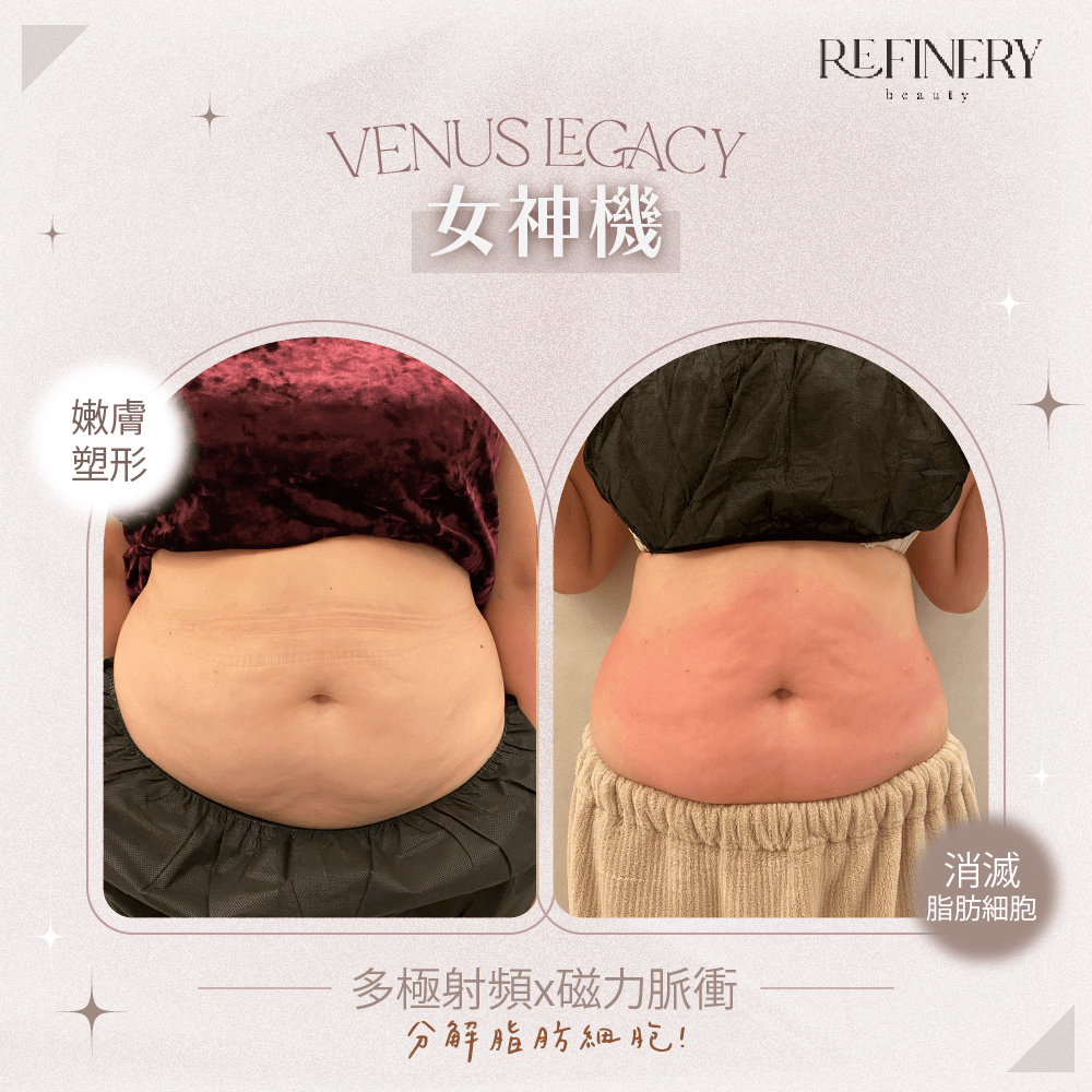 香港 Refinery Beauty 公開的 Venus Legacy 腹部前後展示照；原圖未清楚列出兩張相片間隔及完整療程次數，已存於本地 assets