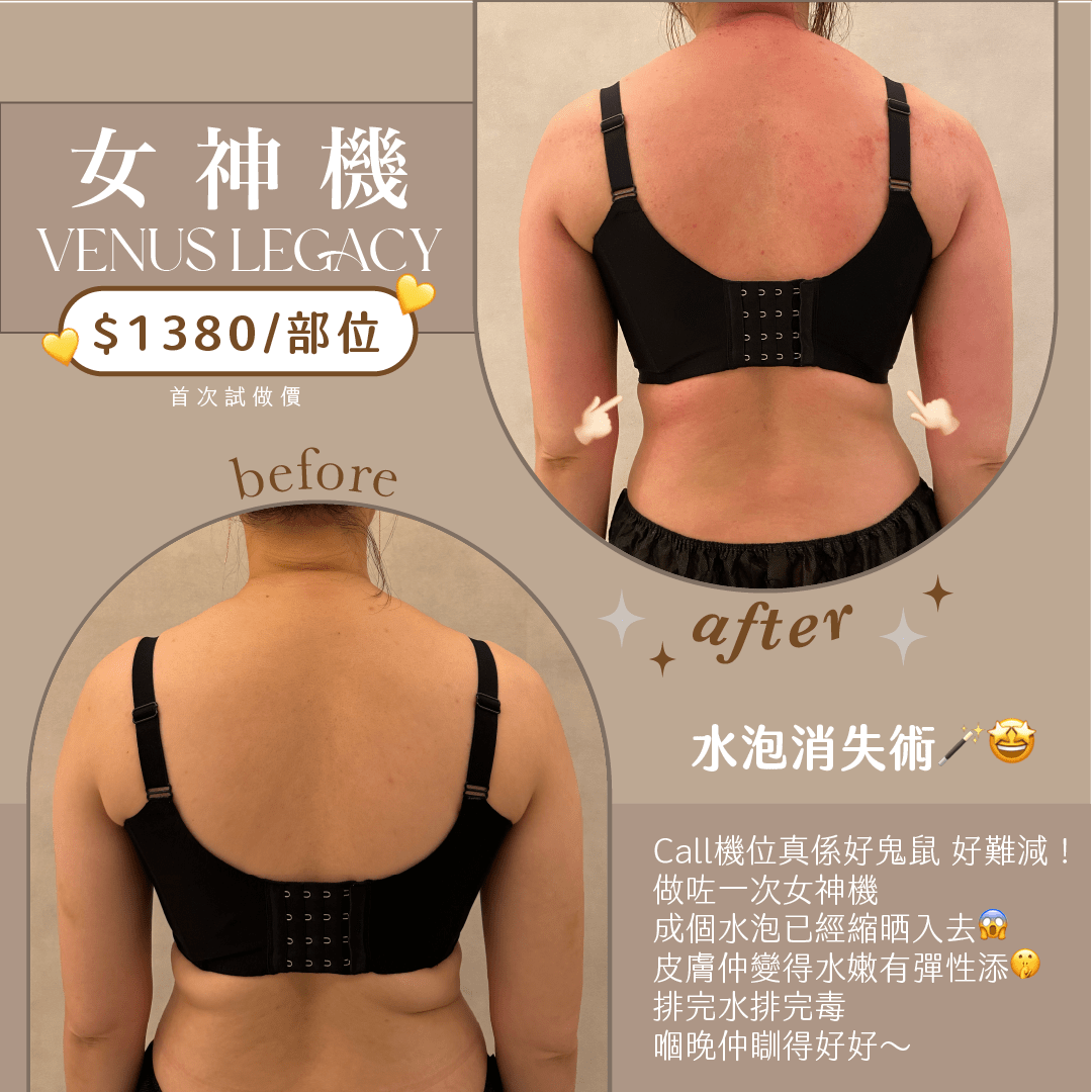 香港 Refinery Beauty 公開的 Venus Legacy 上背部前後展示照；店家原圖未交代完整拍攝時間與療程次數，已存於本地 assets