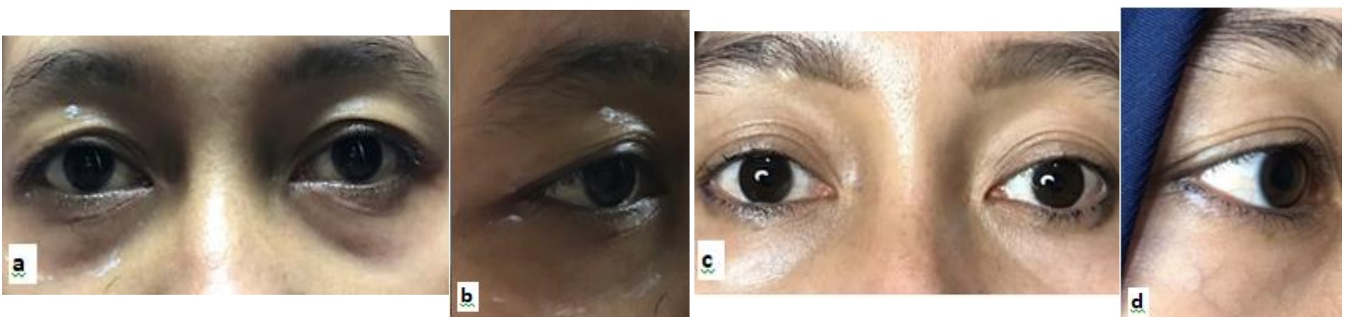 JPAD 2024 輕度上眼皮鬆弛病例照:A、B 為療程前,C、D 為單次電漿微點凝固後一個月
