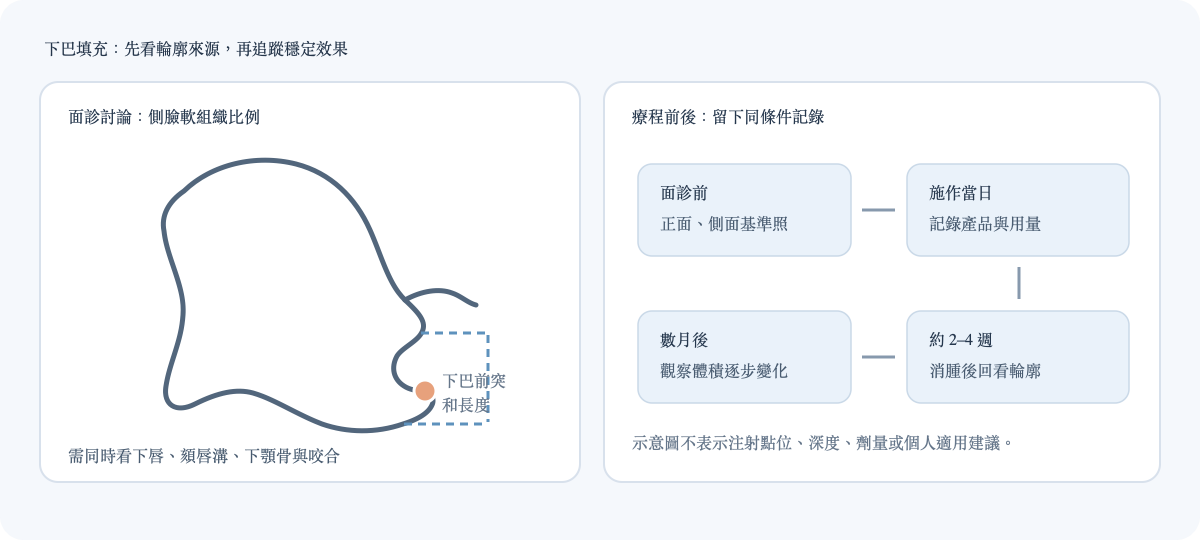 下巴填充面診評估方向與療程後效果追蹤示意
