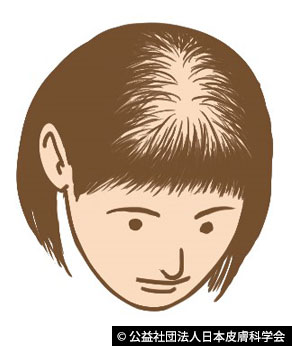 日本皮膚科學會患者資料中的女性型落髮頭頂示意圖