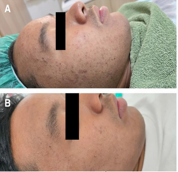 17 歲患者複合 spicule+0.5% BHA 煥膚三次前後病例照,原圖 Figure 1,CC BY 4.0