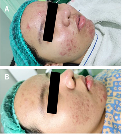 19 歲患者複合 spicule+0.5% BHA 煥膚三次前後病例照,原圖 Figure 2,CC BY 4.0