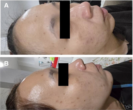 36 歲患者複合 spicule+0.5% BHA 煥膚三次前後病例照,原圖 Figure 4,CC BY 4.0
