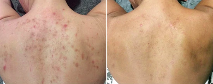 院所公開的上背部 BodyPeel 療程前後對照;原圖已下載至本地素材
