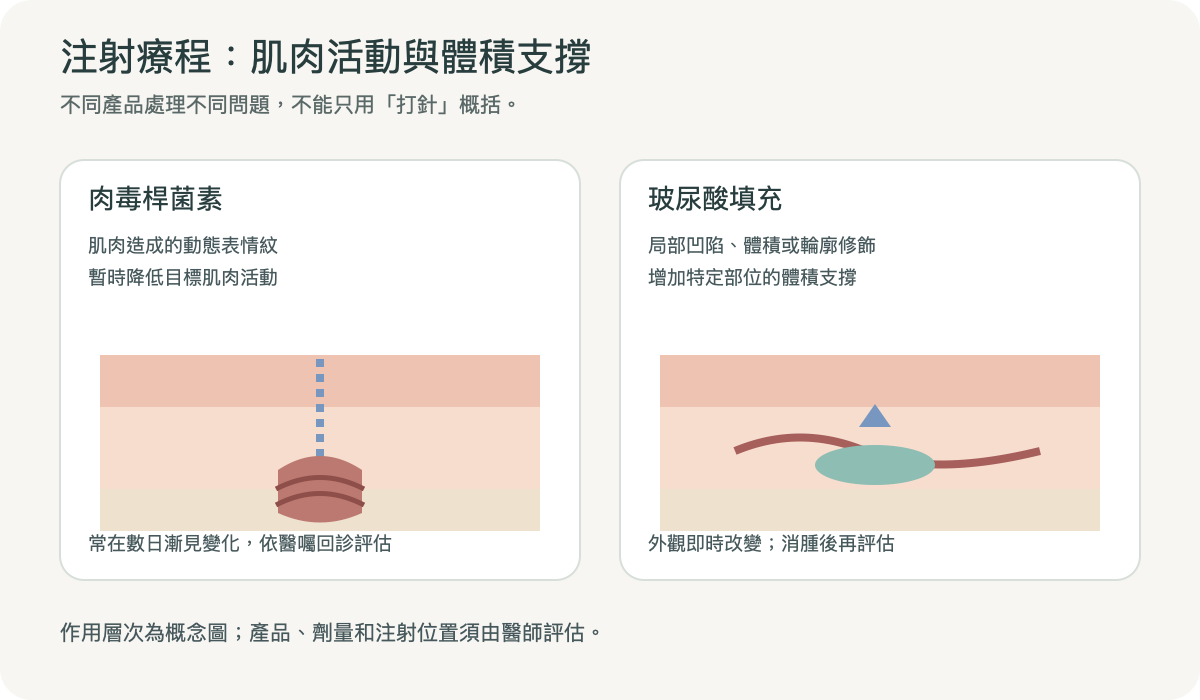肉毒桿菌素作用於肌肉活動、玻尿酸支撐局部體積的層次示意