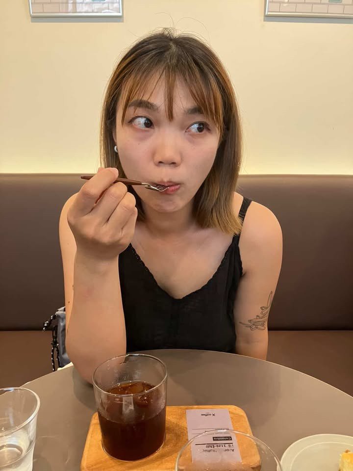 台灣院所公開個案:淚溝玻尿酸填充術前照片,已存入專案